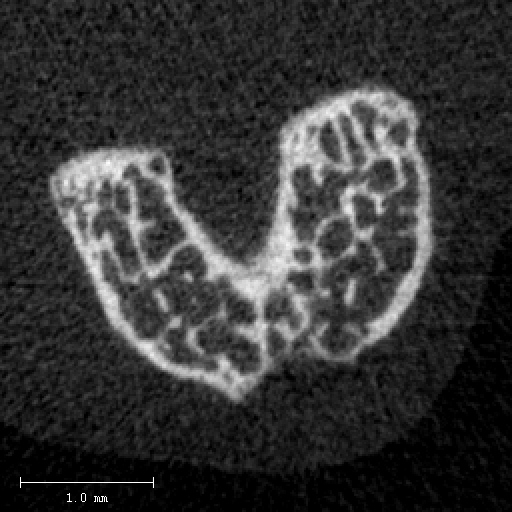 File:Vivact40 in-vivo dist femur.jpg